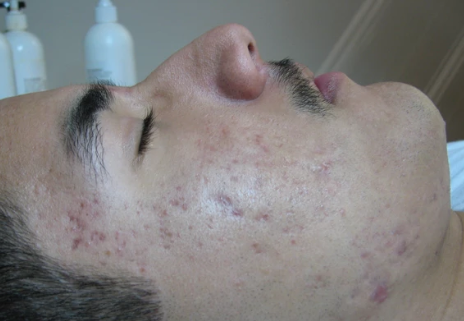 inflamed acne after