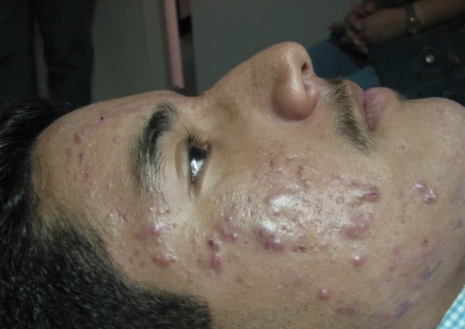 inflamed acne before