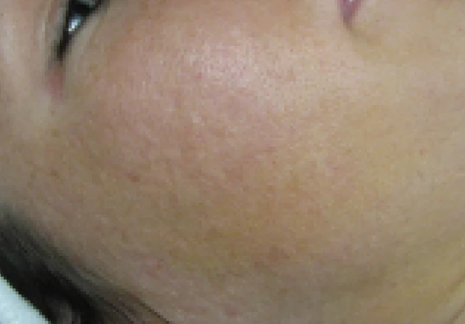 noninflamed acne after