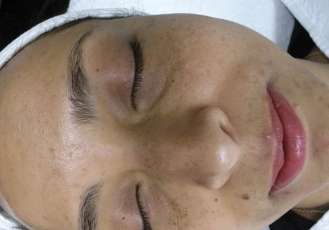 acne hyperpigmentation