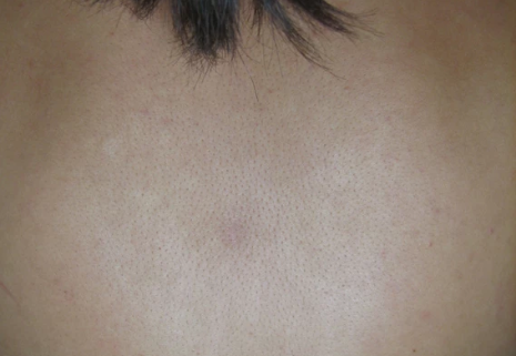 back acne after