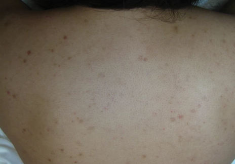back acne before
